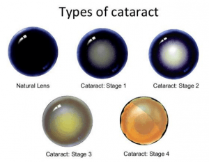 Types of Cataract